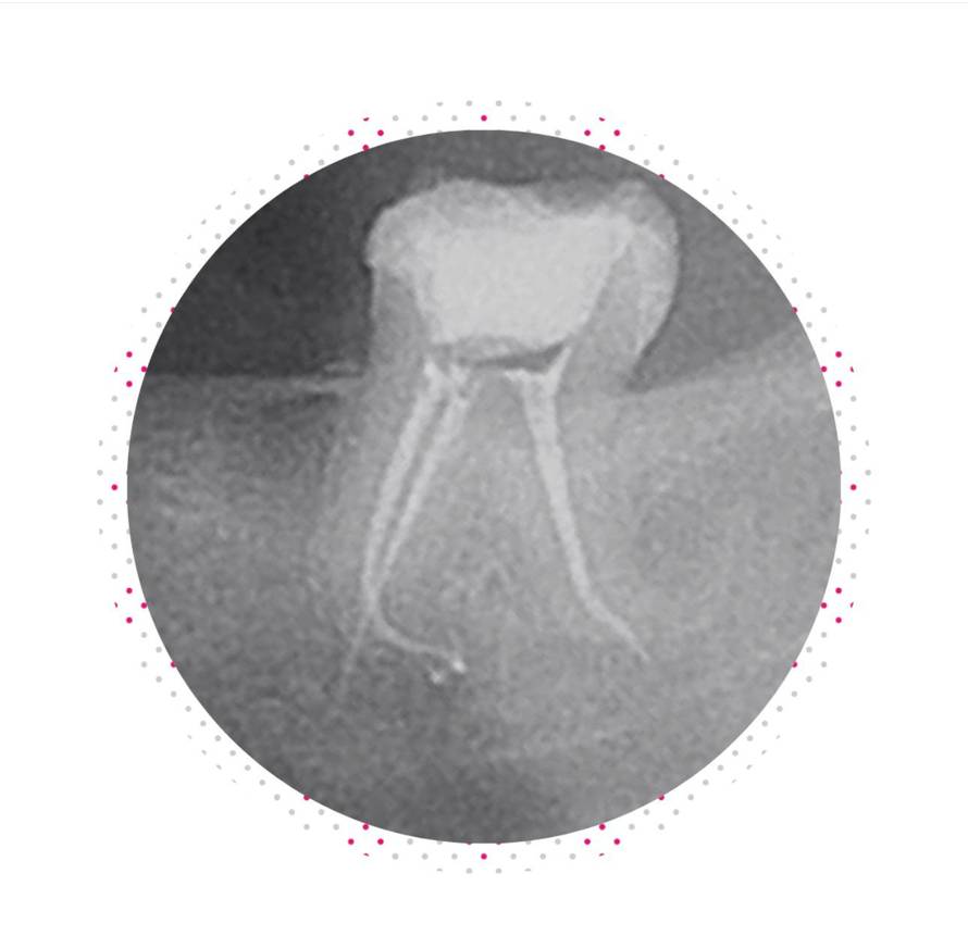 Značaj specijalista za korijenske kanale u stomatologiji