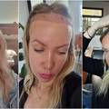Transplatirala je kosu zbog velikog čela: 'To nije samo za muškarce, ja sam jako sretna'