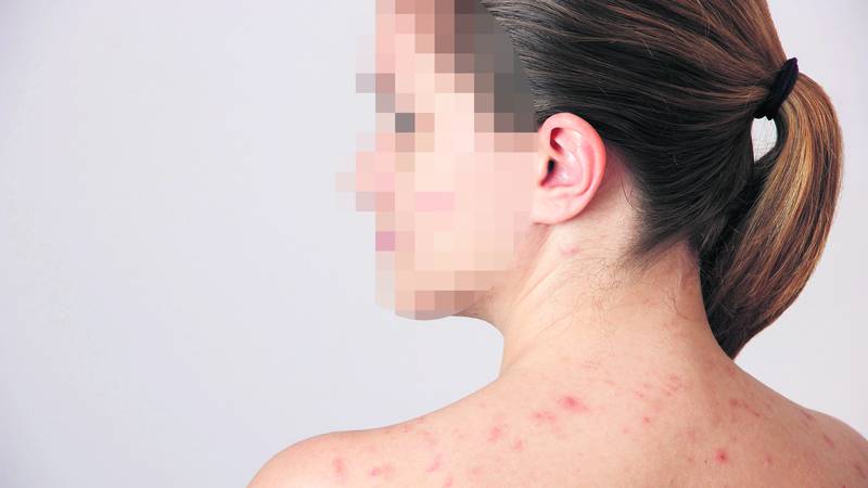 Ospice jenjavaju u Europi, ali u WHO su zabrinuti zbog Sjeverne Amerike jer je Svjetsko sve bliže