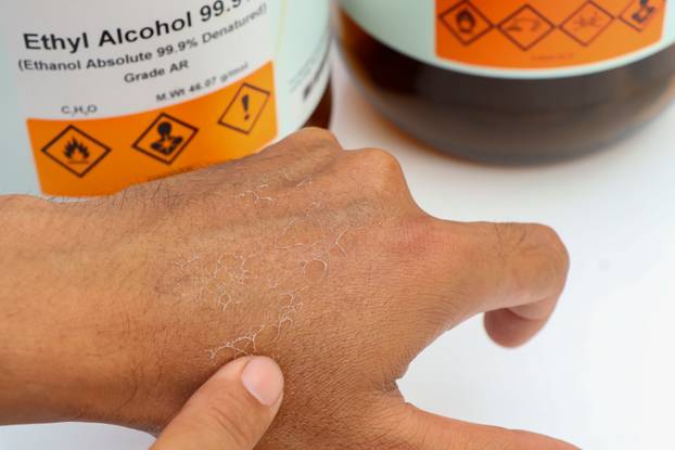 Skin abrasions caused by corrosive chemical , chemistry in the laboratory 