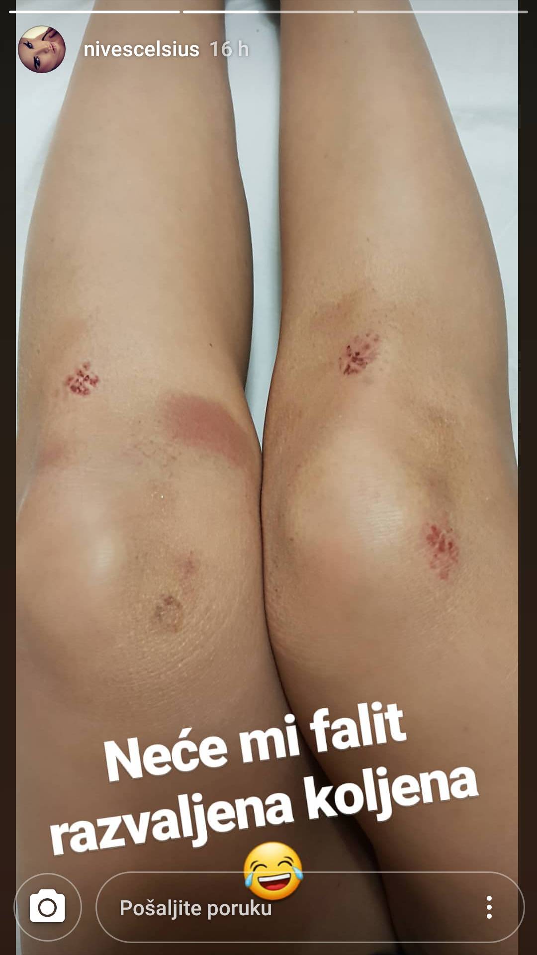 Pokazala je rane nakon plesa: Neće mi faliti razbijena koljena