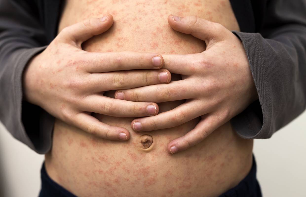 Prepoznajte ospice: Od prvih simptoma do osipa čak 14 dana