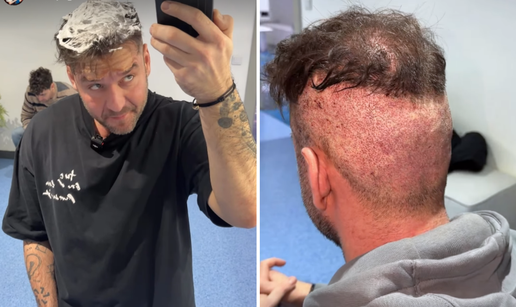 Zanima vas kako izgleda transplantacija kose? Sandi Pego otkrio detalje operacije