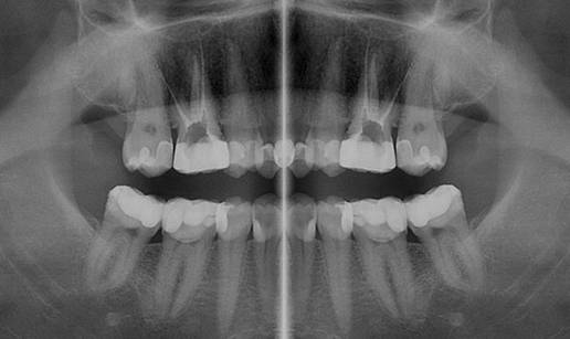 Jednoposjetna endodoncija: Transformacija osmijeha jednim posjetom