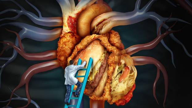 High Cholesterol Treatment