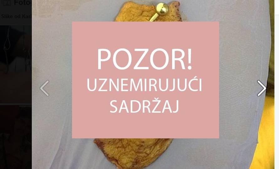 Kirurški odstranio bradavice pa je od njih napravio naušnice