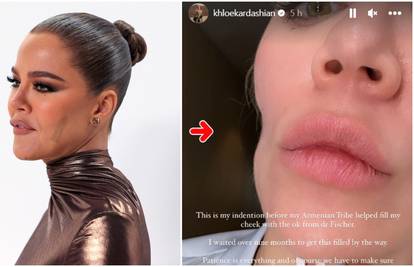 Khloe Kardashian pokazala lice nakon operacije: 'Imala sam rak kože, ostalo mi je udubljenje...'
