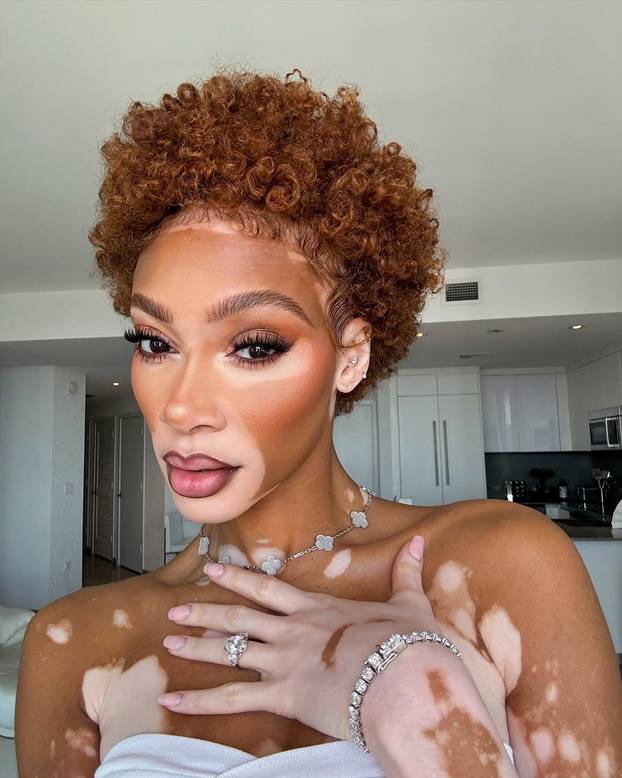 FOTO Rugali su joj se zbog bolesti, a danas je obožavaju zbog jedinstvenog izgleda