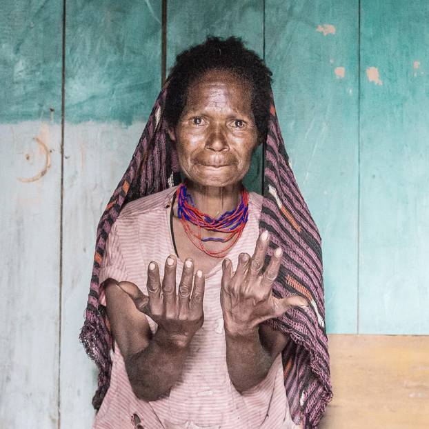 Missing fingers. Dani tribe ladies cut off their fingers to demonstrate their pain at the loss of a younger family member. West Papua, Indonesia