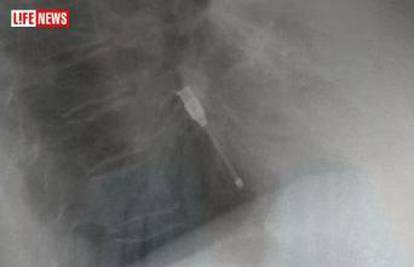 Ženi (61) operirali srce i ostavili joj iglu u prsima 