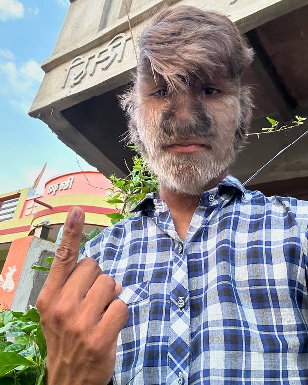 FOTO Ovaj mladić (18) pati od sindroma vukodlaka: U školi me sprdaju, ali volim svoje dlake...