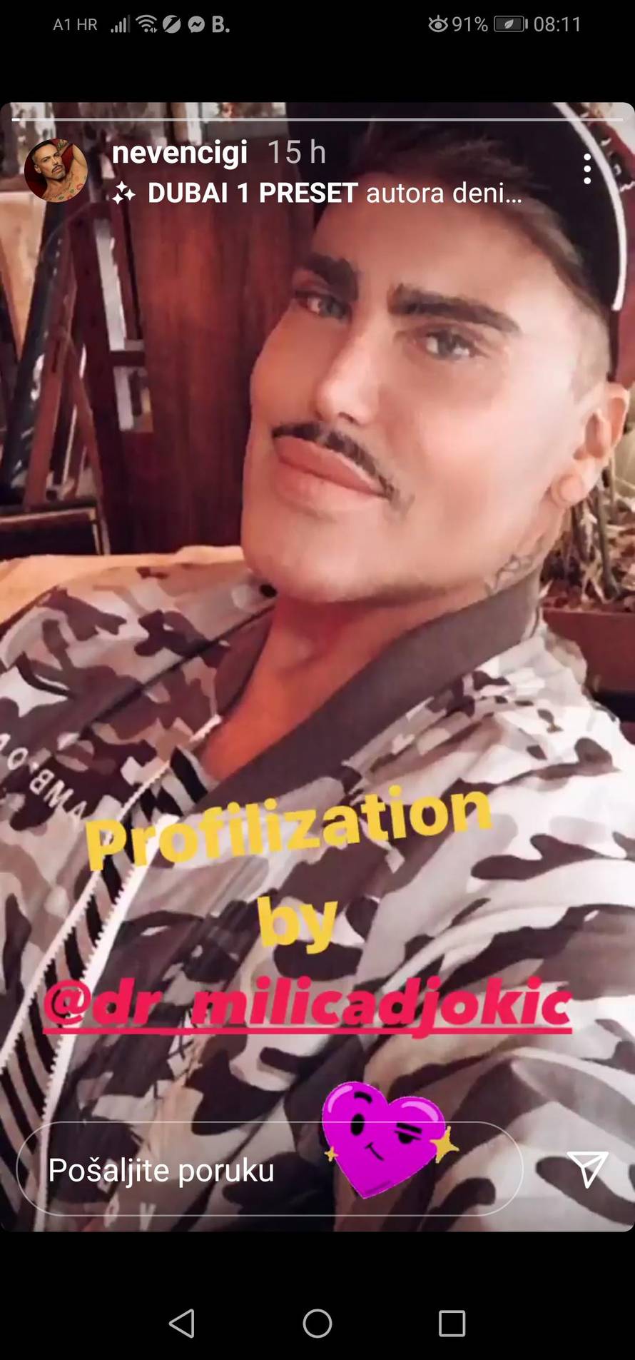 Cigi ubrizgao svoje salo da ima baby čelo: 'Izgledam sad mlađe'