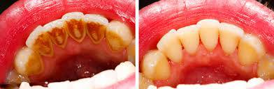 Riješite se zubnog kamenca doma i odstranite loš zadah
