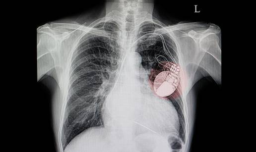 Neispravni uređaji za srce se povlače: Ima ih i u Hrvatskoj