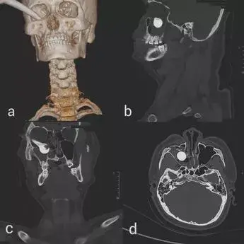 Medicinsko čudo! Tinejdžeru se u oko zabila ručica kočnice od 17 cm! S tim su ga vozili na hitnu