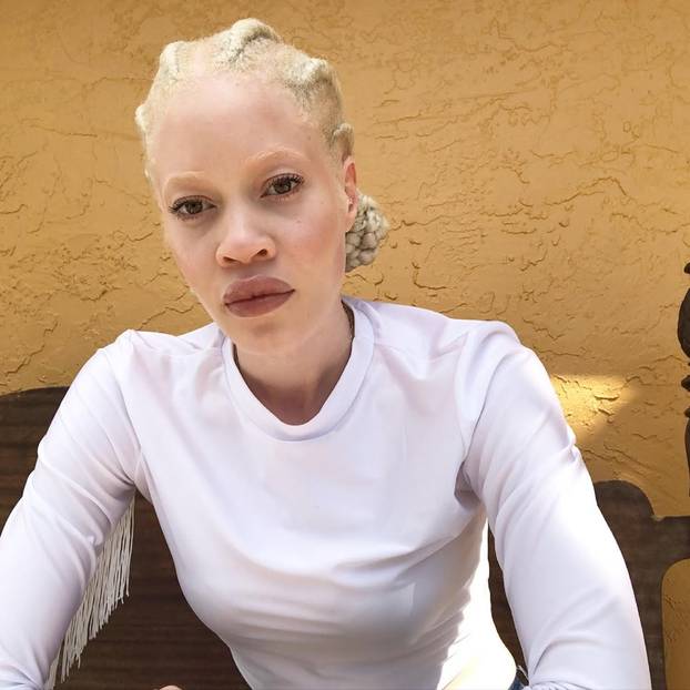 FOTO Afrikanka s albinizmom osvaja modnu industriju: 'Često privlačim znatiželjne poglede'