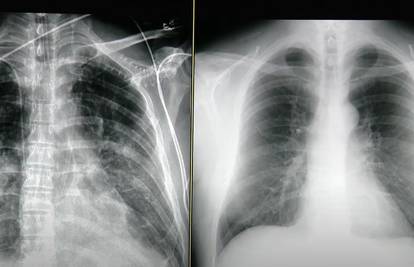 Ovako izgledaju pluća pacijenta iz Zagreba koji ima korona virus