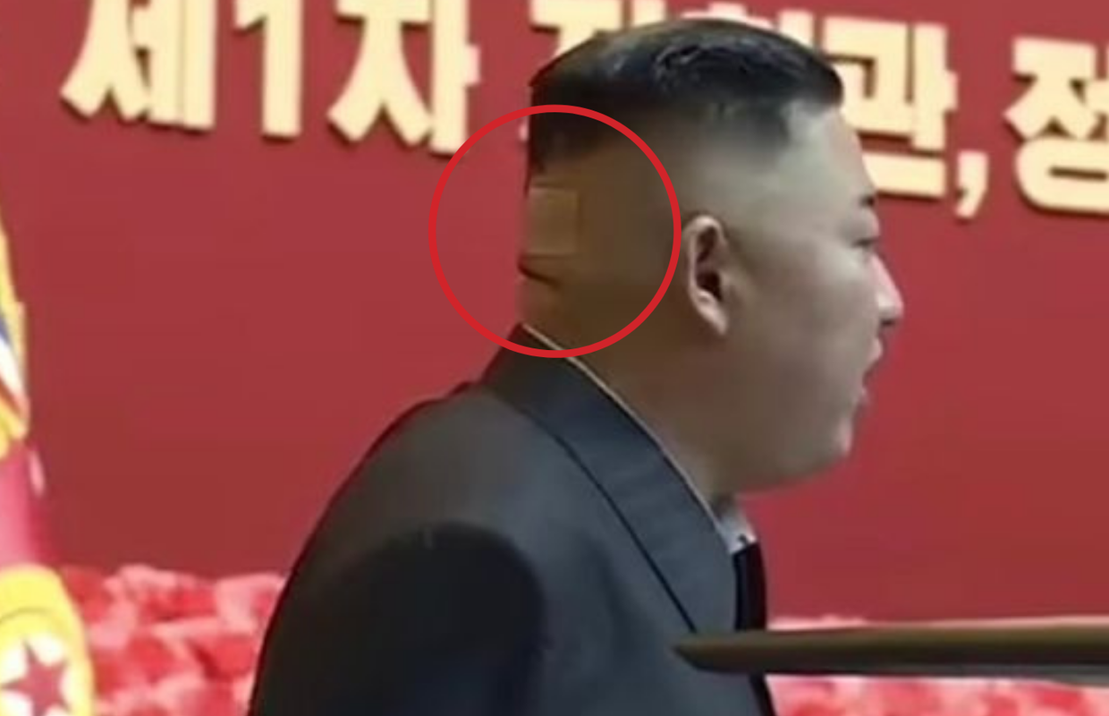 Misteriozna rana Kim Jong Una: Snimili ga s flasterom i mrljom na glavi - što mu se dogodilo?
