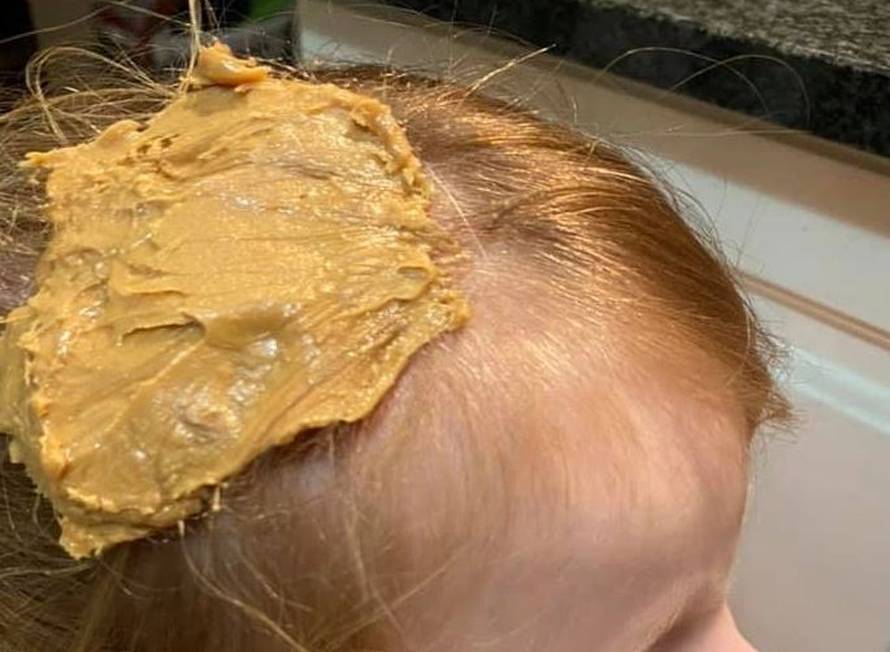 Žvaku zapetljanu u kosi mama je izvukla namazanim maslacem