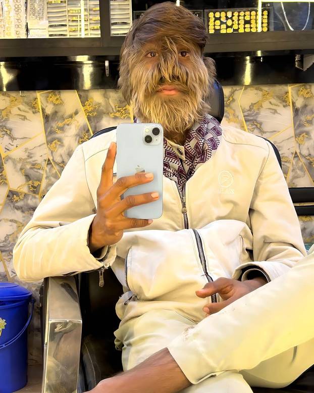 FOTO Ovaj mladić (18) pati od sindroma vukodlaka: U školi me sprdaju, ali volim svoje dlake...