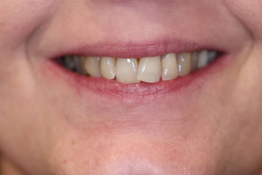 Osmijeh koji izgleda prirodno? Tajna je u preciznom planiranju i kvalitetnom materijalu