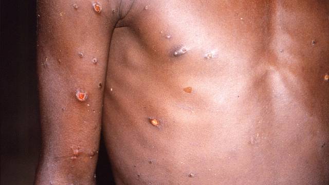 FILE PHOTO: A CDC image shows skin lesions on a monkeypox patient