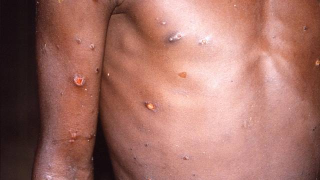 FILE PHOTO: A CDC image shows skin lesions on a monkeypox patient