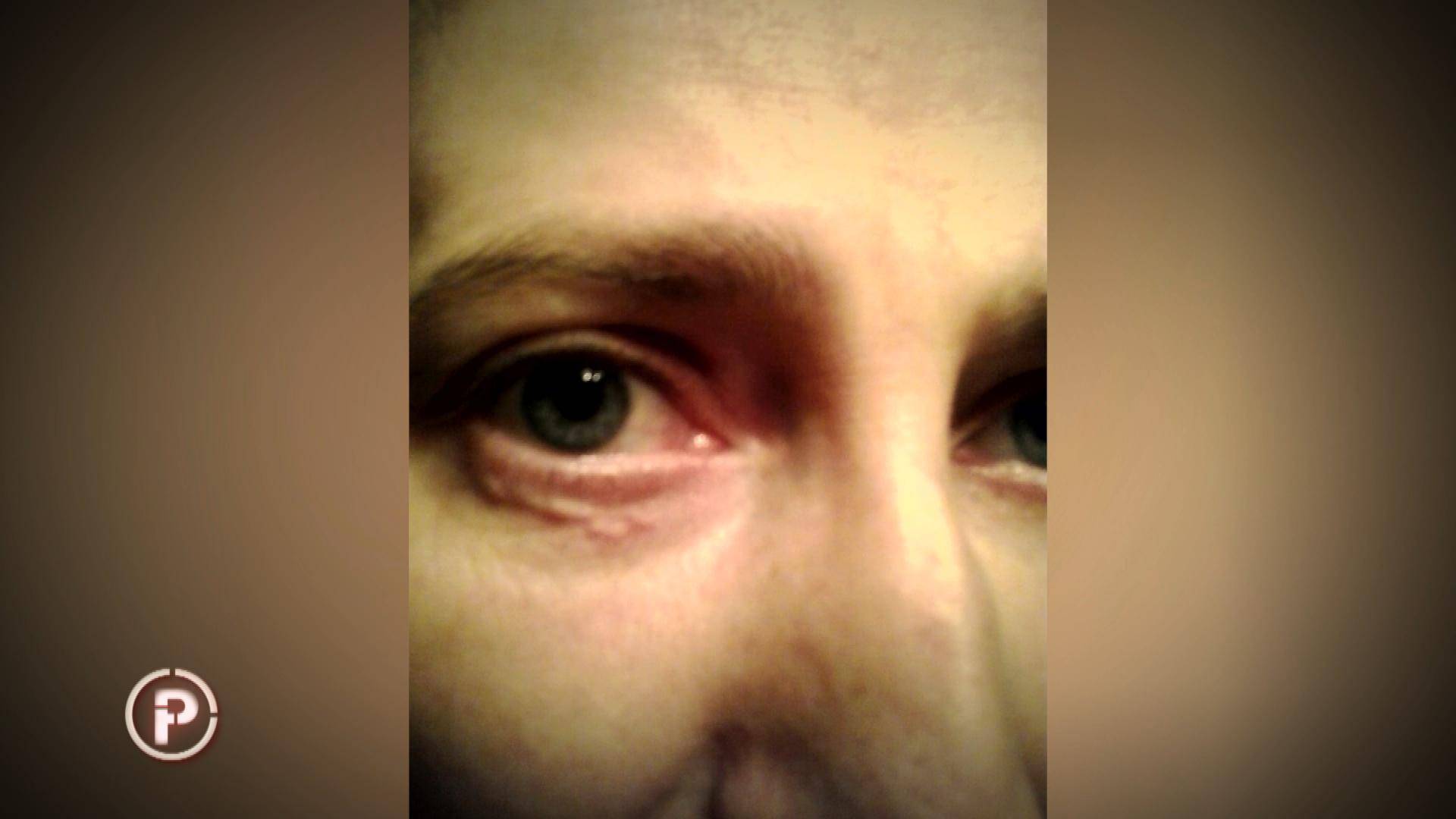 Mireli je ugriz komarca 'donio' crva u oku: 'Osjetim gmizanje'