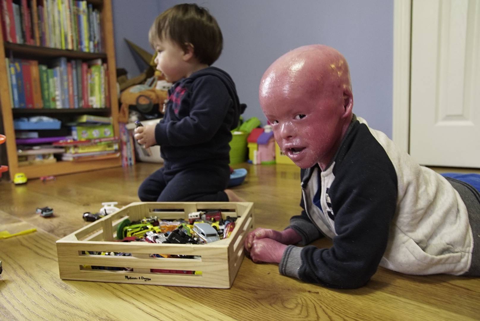 Harlequin Ichthyosis: The Boy Whose Skin Grows Too Fast