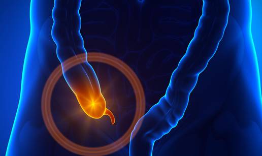 Ne ignorirajte upalu slijepog crijeva - možete dobiti sepsu...