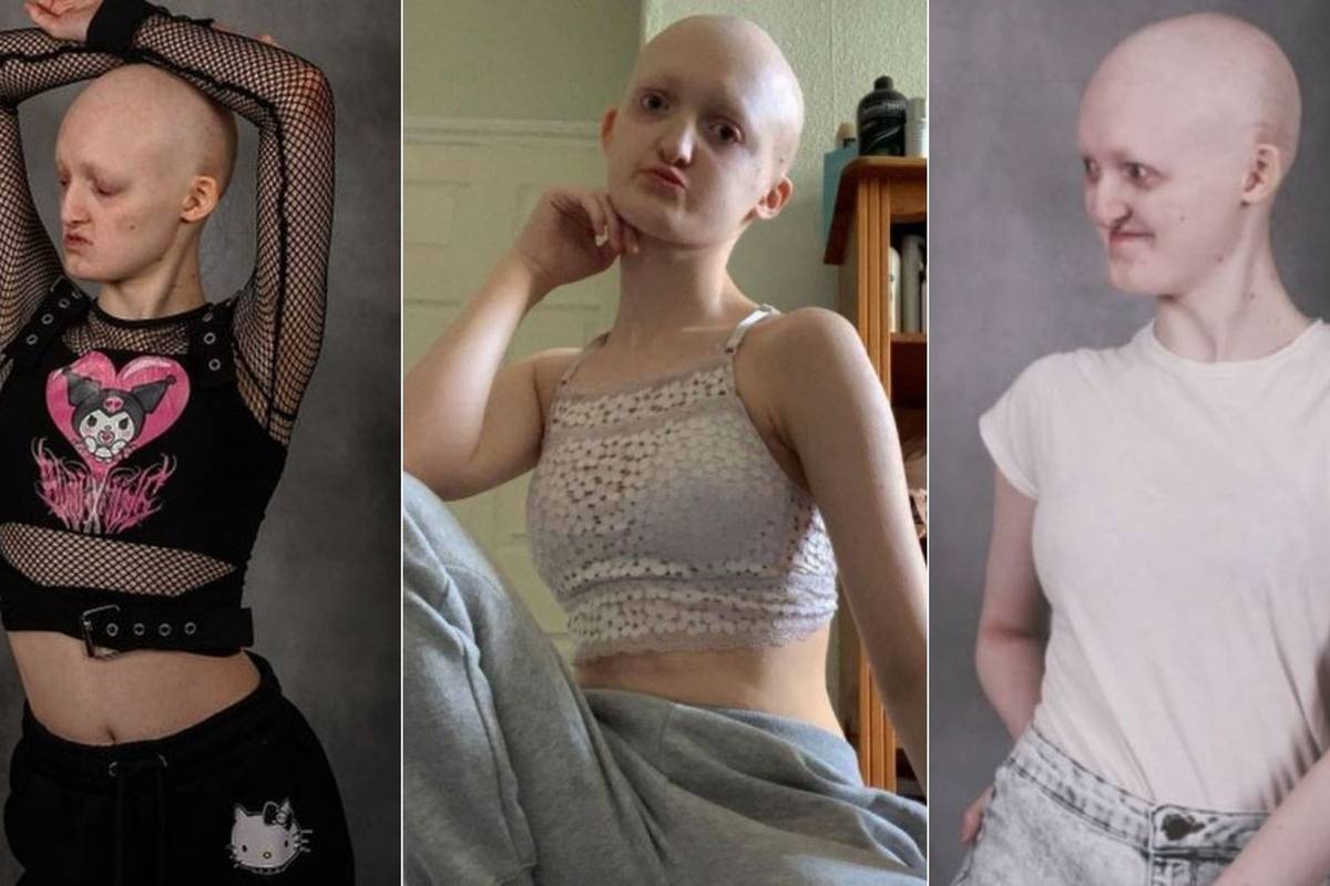 Gluha i bez kose zbog sindroma kojeg ima 30 ljudi, a danas je model: Pljuvali su me, vrijeđali