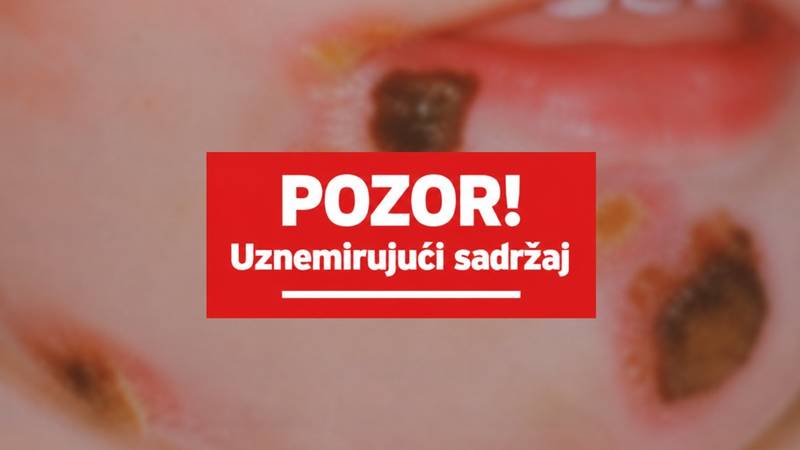 Što je impetigo? Zarazna infekcija kože širi se Jadranom, a najčešće pogađa djecu