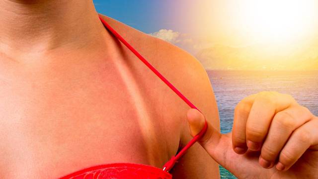 Pripremite kožu za sunčanje prije godišnjeg: 'Prave alergije samo na sunce su vrlo rijetke'
