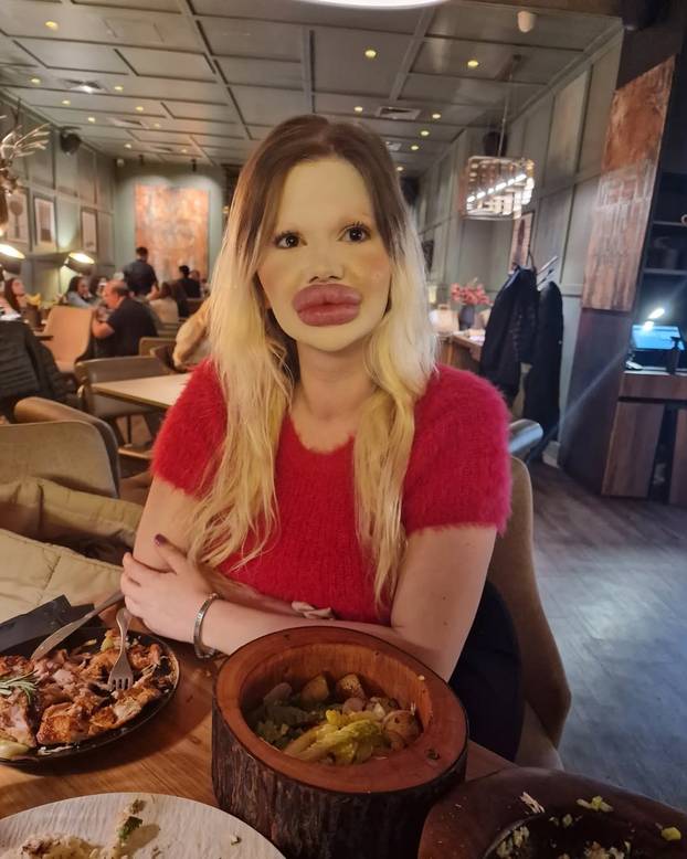 FOTO Žena s najvećim usnama na svijetu otkrila kako je nekoć izgledala: Šok! Bila si prekrasna